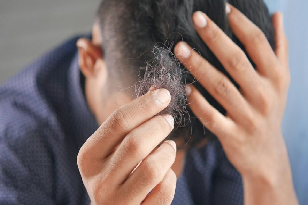 کدام افراد بیشتر در معرض ریزش مو هستند؟